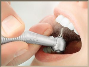 آملگام دندانی