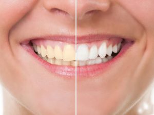 کاربردهای باندینگ دندان